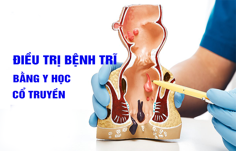 Điều trị bệnh trĩ (hạ trĩ) theo Y học cổ truyền
